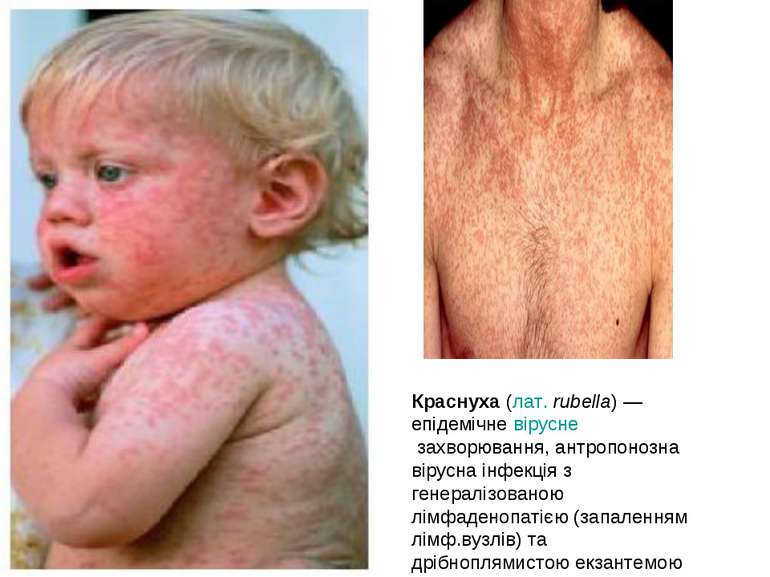 Краснуха (лат. rubella) — епідемічне вірусне захворювання, антропонозна вірус...