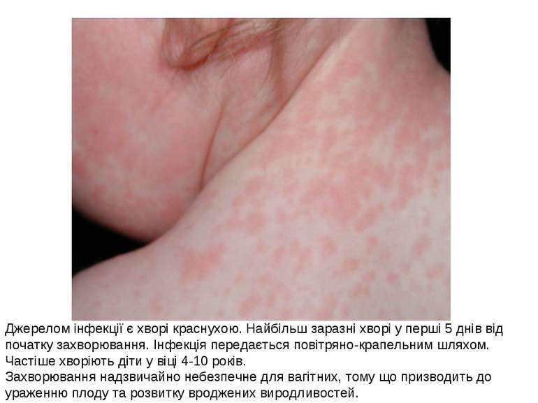 Джерелом інфекції є хворі краснухою. Найбільш заразні хворі у перші 5 днів ві...