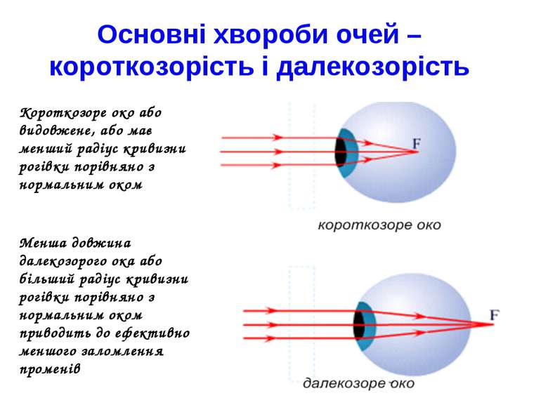 Короткозоре око або видовжене, або має менший радіус кривизни рогівки порівня...