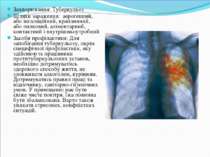 Захворювання: Туберкульоз Шляхи зараження:  аерогенний, або інгаляційний, кра...