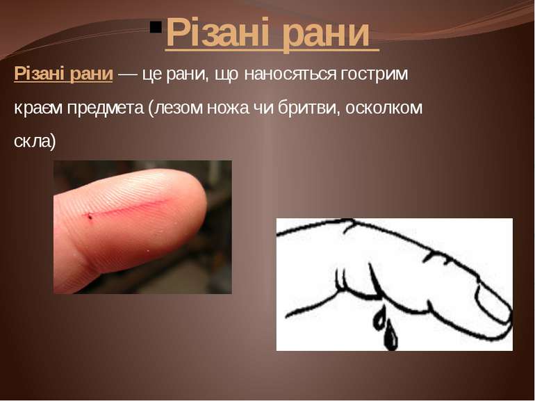 Різані рани Різані рани — це рани, що наносяться гострим краєм предмета (лезо...