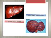 Печінка людини, хворої на гепатит Печінка здорової людини