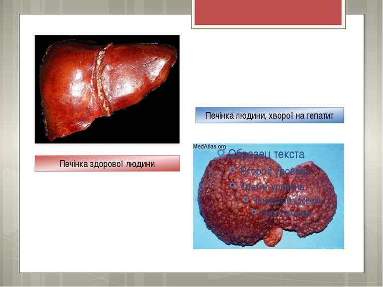 Печінка людини, хворої на гепатит Печінка здорової людини