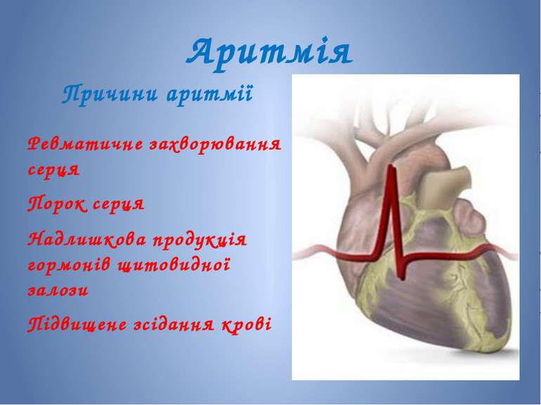 Аритмія Причини аритмії Ревматичне захворювання серця Порок серця Надлишкова ...