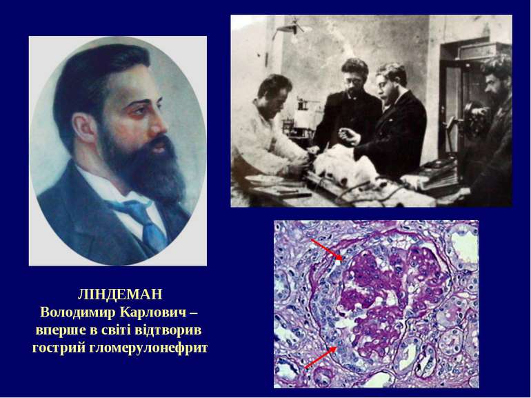 ЛІНДЕМАН Володимир Карлович – вперше в світі відтворив гострий гломерулонефрит