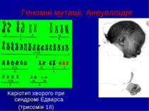 Геномні мутації. Анеуплоїдія Каріотип хворого при синдромі Едварса (трисомія 18)