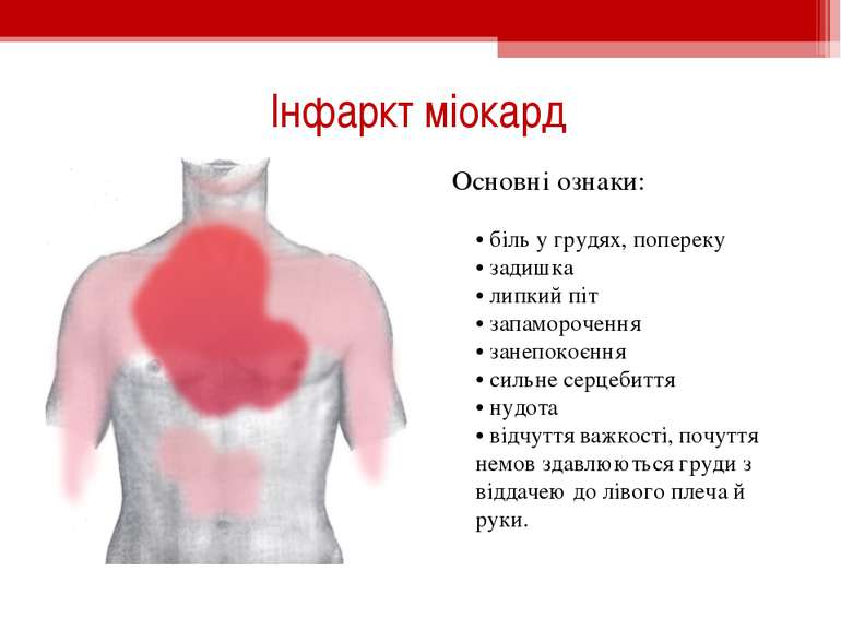 Інфаркт міокард Основні ознаки: • біль у грудях, попереку • задишка • липкий ...