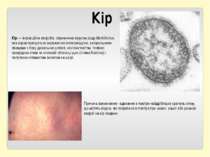 Кір Кір — інфекційна хвороба, спричинена вірусом роду Morbillivirus, яка хара...