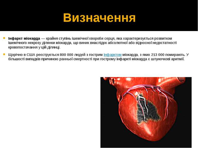 Визначення Інфаркт міокарда — крайня ступінь ішемічної хвороби серця, яка хар...