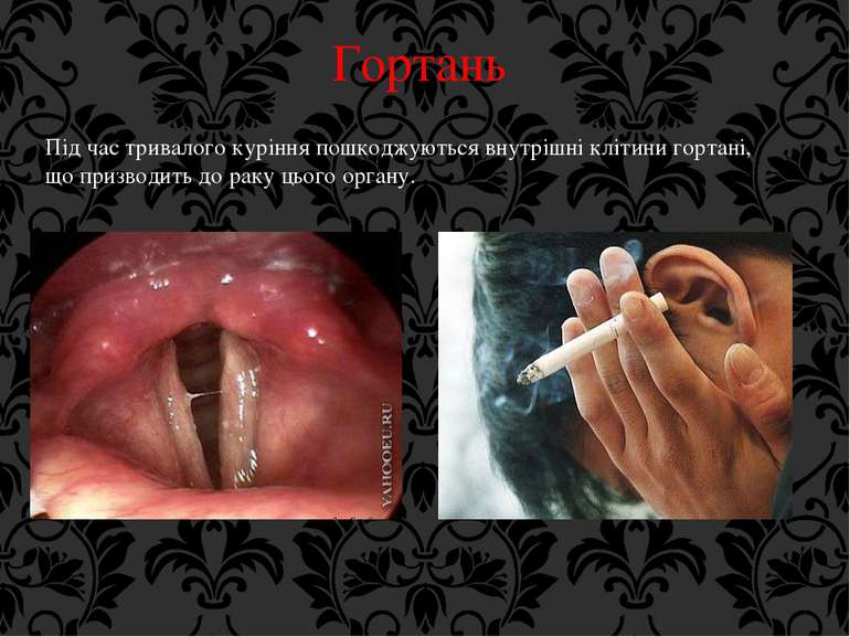 Гортань Під час тривалого куріння пошкоджуються внутрішні клітини гортані, що...