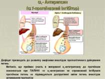 1- Антирипсин (a1-протеїназний інгібітор) Дефіцит призводить до розвитку емфі...