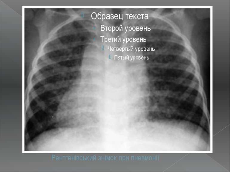 Рентгенівський знімок при пневмонії