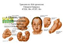 Трисомія по 18-й хромосомі Синдром Едвардса 47,ХХ, 18+; 47,ХY, 18+