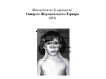 Моносомія по Х-хромосомі Синдром Шерешевського-Тернера (ХО)