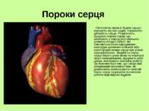 Пороки серця Патологічні зміни в будові серця і відходять від них судин, пору...