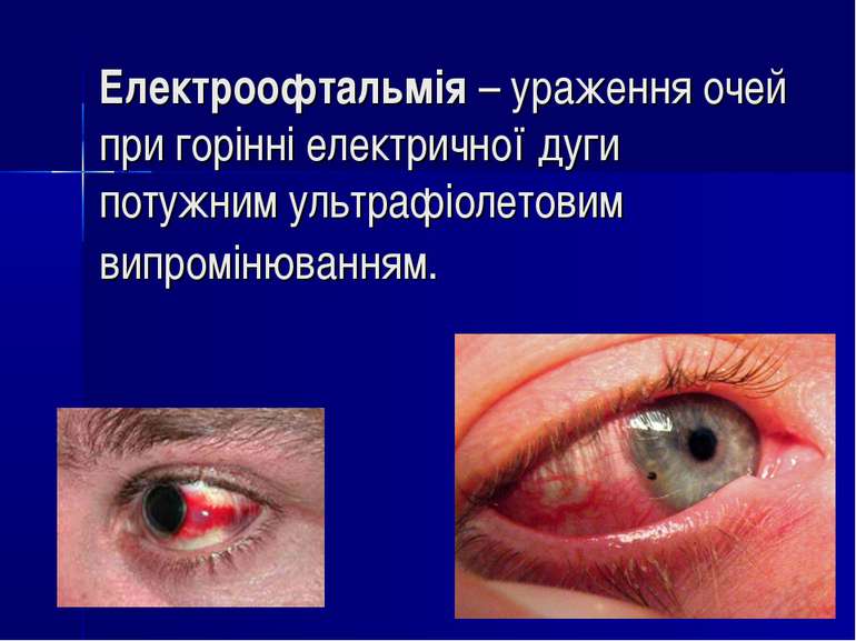 Електроофтальмія – ураження очей при горінні електричної дуги потужним ультра...