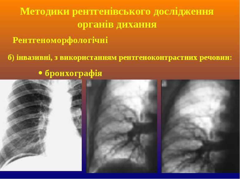 б) інвазивні, з використанням рентгеноконтрастних речовин: бронхографія Метод...