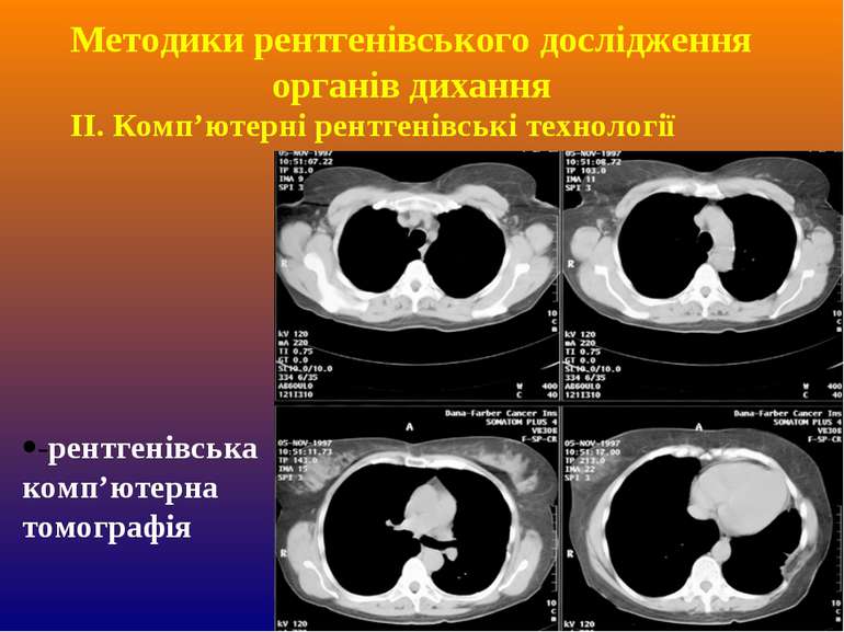 ІІ. Комп’ютерні рентгенівські технології -рентгенівська комп’ютерна томографі...
