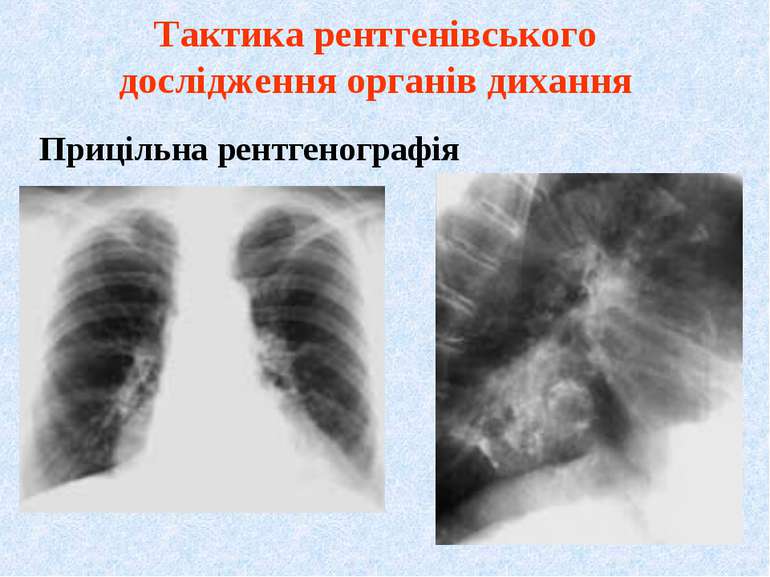 Прицільна рентгенографія Тактика рентгенівського дослідження органів дихання