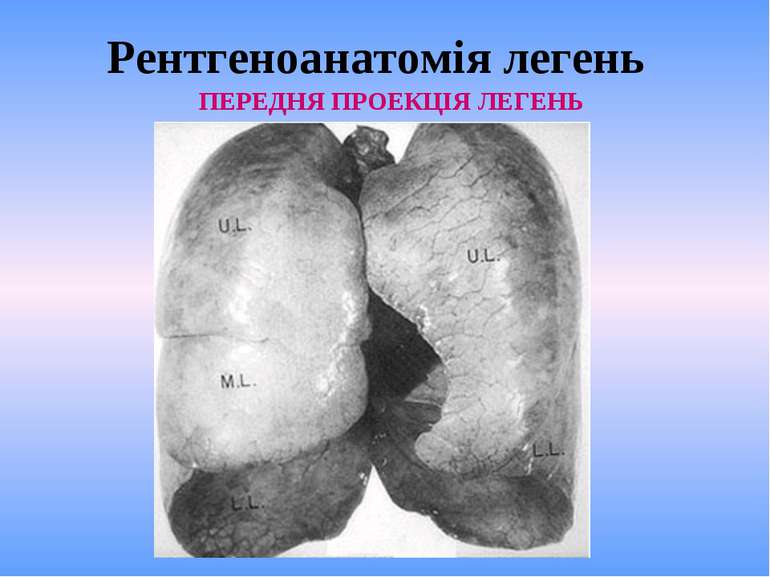 Рентгеноанатомія легень ПЕРЕДНЯ ПРОЕКЦІЯ ЛЕГЕНЬ