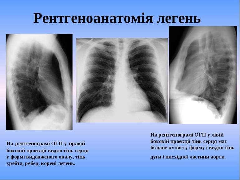 Рентгеноанатомія легень На рентгенограмі ОГП у лівій боковій проекції тінь се...