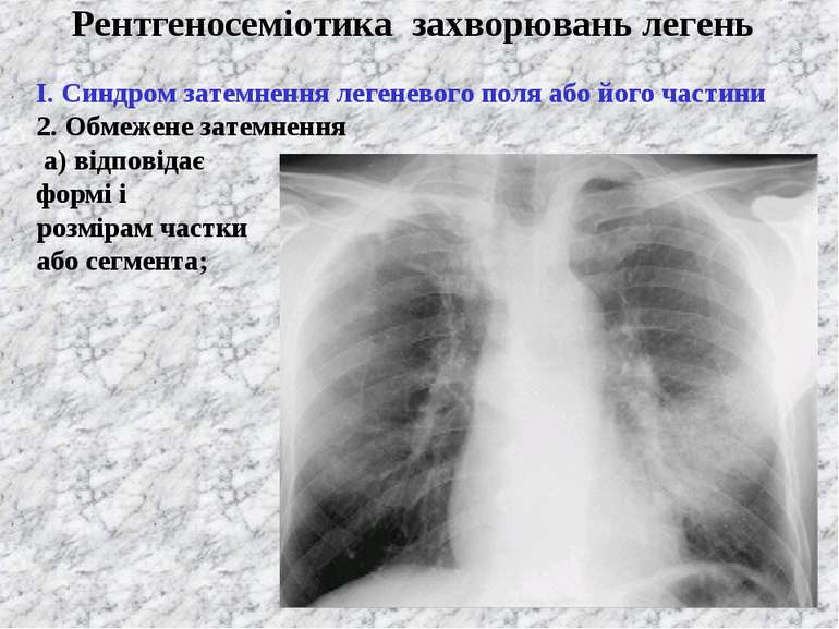 Рентгеносеміотика захворювань легень