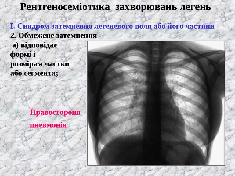 Рентгеносеміотика захворювань легень І. Синдром затемнення легеневого поля аб...