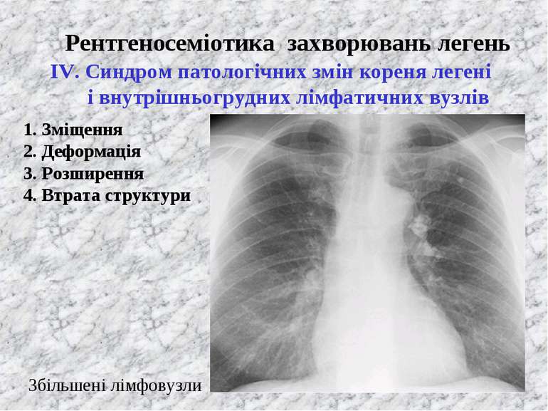 Рентгеносеміотика захворювань легень ІV. Синдром патологічних змін кореня лег...