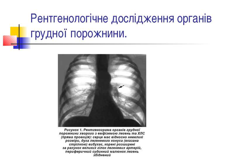 Рентгенологічне дослідження органів грудної порожнини.