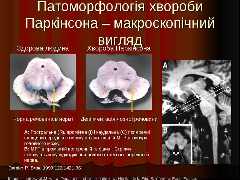Патоморфологія хвороби Паркінсона – макроскопічний вигляд Damier P, Brain 199...
