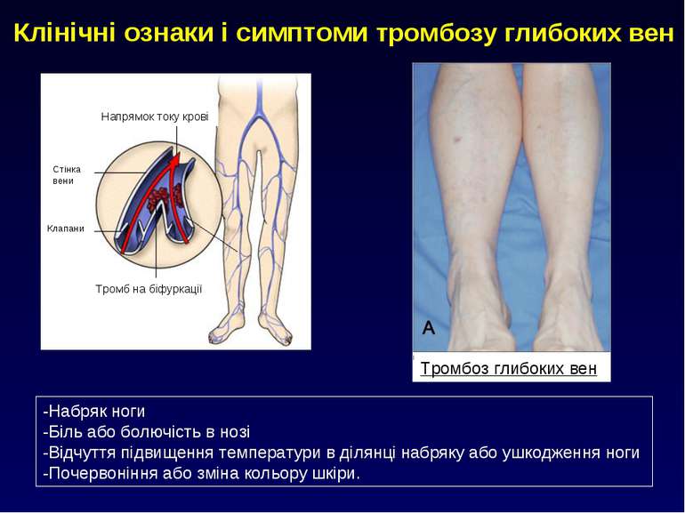 Клінічні ознаки і симптоми тромбозу глибоких вен Тромбоз глибоких вен -Набряк...
