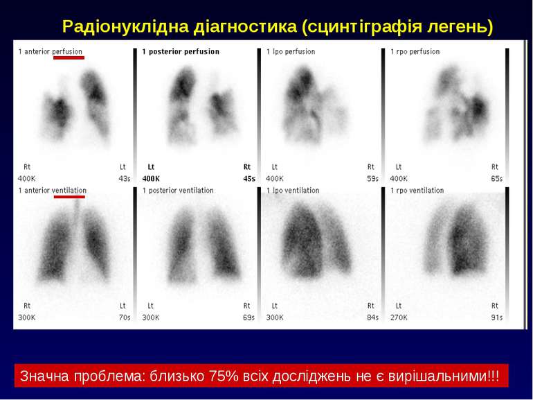 Радіонуклідна діагностика (сцинтіграфія легень) Значна проблема: близько 75% ...