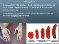 Прикладами є: арахнодактилія “павучі пальці”- формуються видовжені пальці на ...