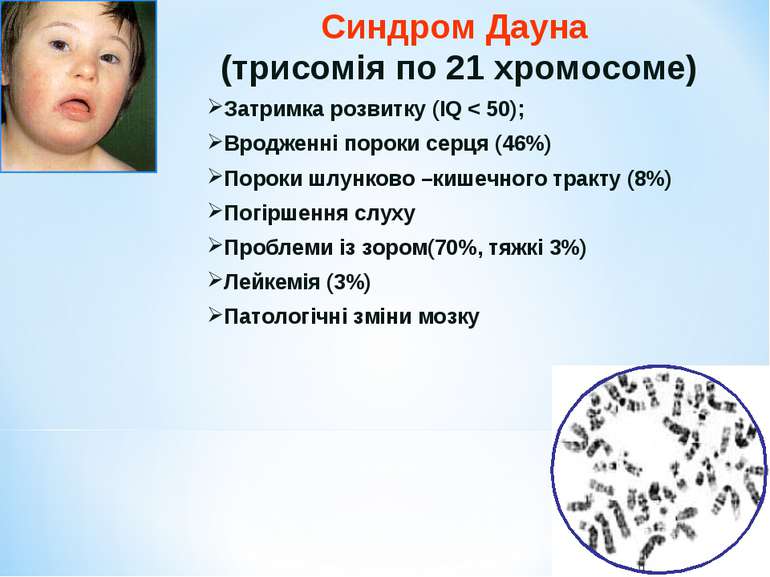Синдром Дауна (трисомія по 21 хромосоме) Затримка розвитку (IQ < 50); Вроджен...
