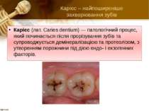 Карієс – найпоширеніше захворювання зубів Карієс (лат. Caries dentium) — пато...
