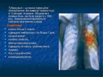 Туберкульоз – це важке інфекційне захворювання, яке вимагає тривалого(до 9-12...