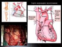 Аорта Аорто-коронарне шунтування Венозний шунт Внутрі-шня грудна артерія