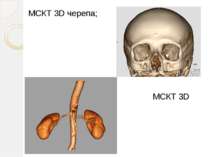 МСКТ 3D черепа; МСКТ 3D нирок;