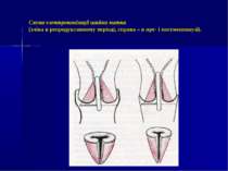 Схема електроконізації шийки матки (зліва в репродуктивному періоді, справа –...