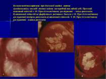 Кольпоскопічна картина при дисплазії шайки матки а)лейкоплакія у вигляді тонк...