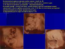 Кольпоскопічні картини при раку шийки матки.( стадії Ia, Ib) а) високоатипови...
