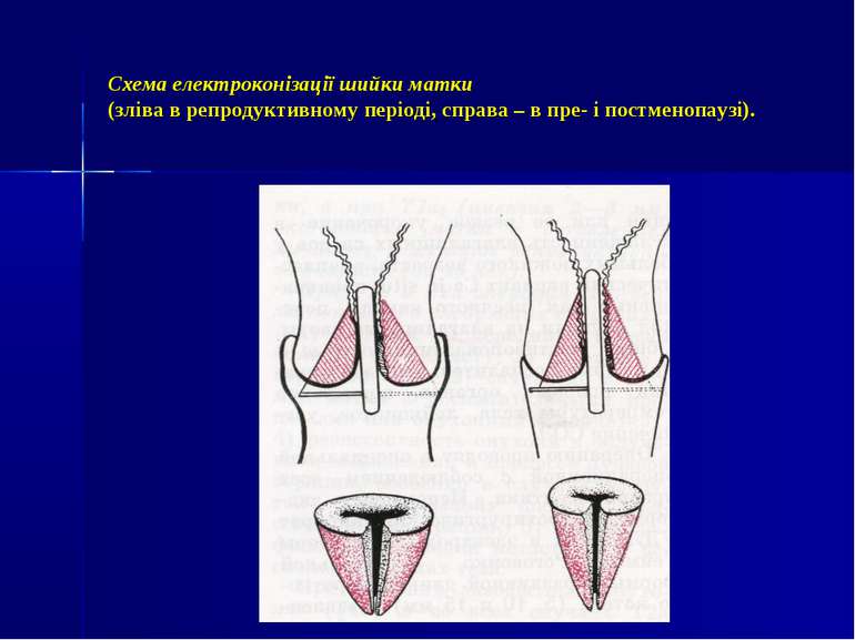 Схема електроконізації шийки матки (зліва в репродуктивному періоді, справа –...
