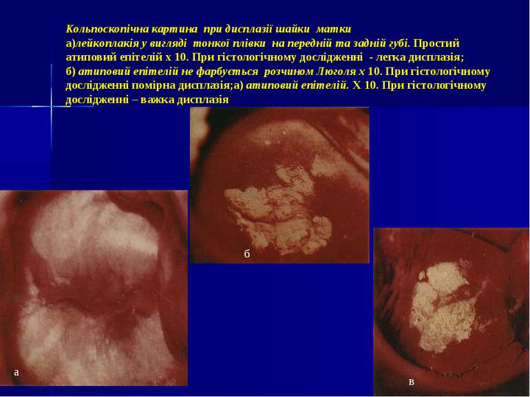 Кольпоскопічна картина при дисплазії шайки матки а)лейкоплакія у вигляді тонк...