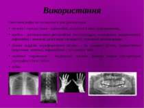 Використання Рентгенографія застосовується для діагностики: легенів і середос...