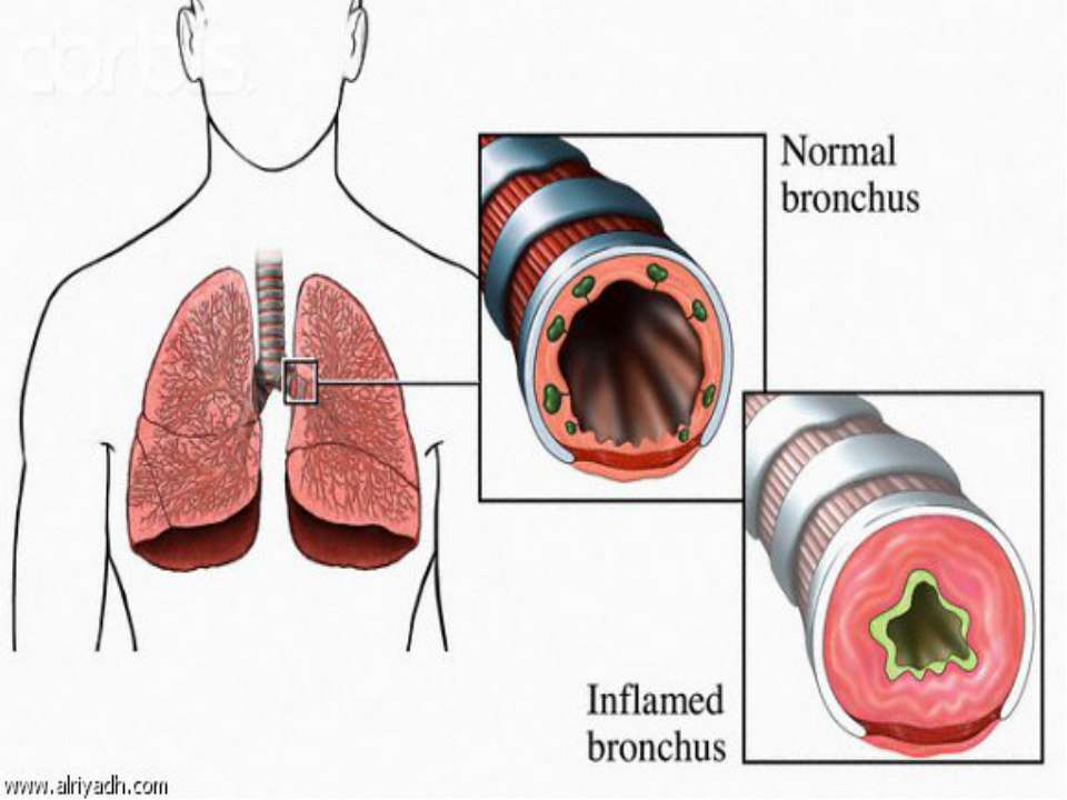 Бронхит история. Бронхиальная астма диагноз по мкб 10. Бронхиальная астма бронхи. Трубка для астмы.