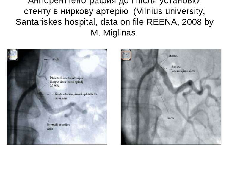 Ангіорентгенография до і після установки стенту в ниркову артерію (Vilnius un...