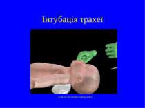 Інтубація трахеї Click on the image to play video