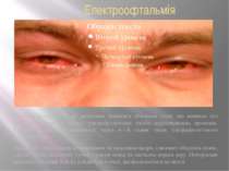 Електроофтальмія Електроофтальмія — це запалення зовнішніх оболонок очей, що ...