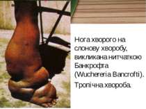 Нога хворого на слонову хворобу, викликана нитчаткою Банкрофта (Wuchereria Ba...