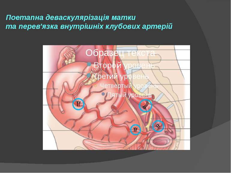 Поетапна деваскулярізація матки та перев'язка внутрішніх клубових артерій